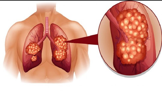  Mbi 700 të prekur në vit me kancer në mushkëri...vetëm nga duhani! 