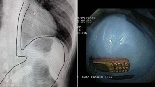 E pazakontë në Kosovë, pacientit i gjendet telefon në stomak